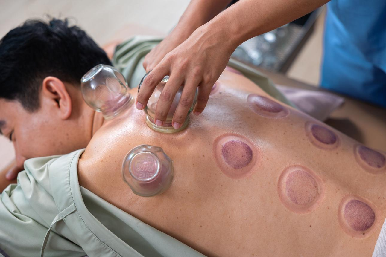 Cupping Therapy at Home