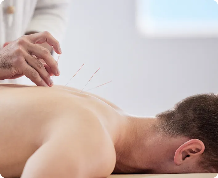 Acupuncture Service at Home